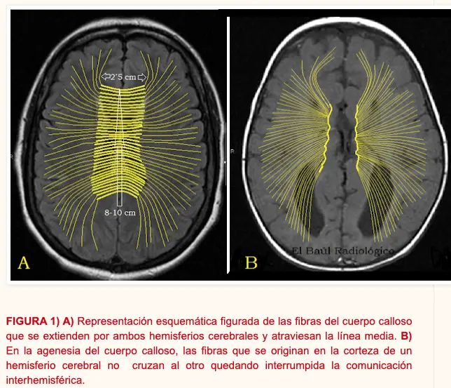 agenesia Etiología y clínica del daño cerebral temprano