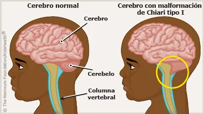 chiari1 Etiología y clínica del daño cerebral temprano