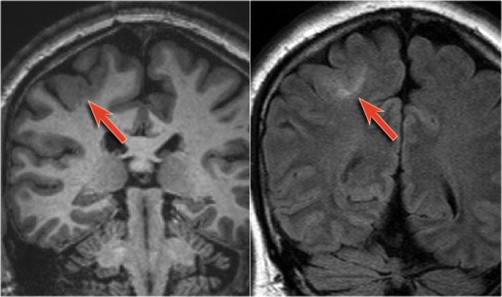 displasia cortical Etiología y clínica del daño cerebral temprano