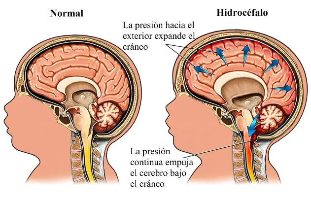 hidrocefalia Etiología y clínica del daño cerebral temprano