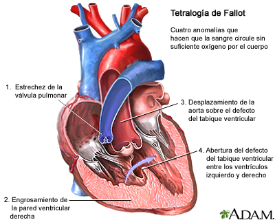 image 2 Cardiopatía congénita