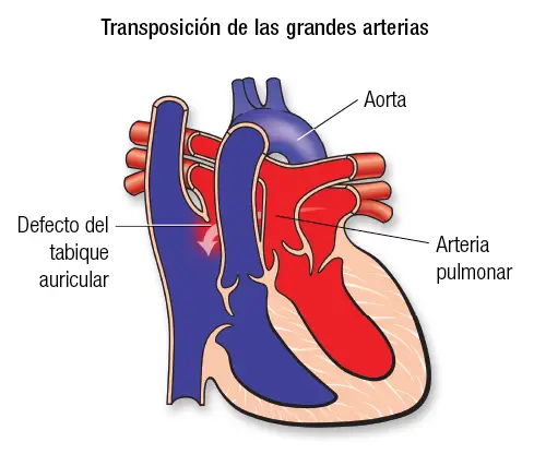 image 3 Cardiopatía congénita