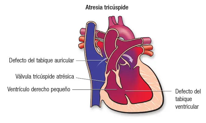 image 5 Cardiopatía congénita
