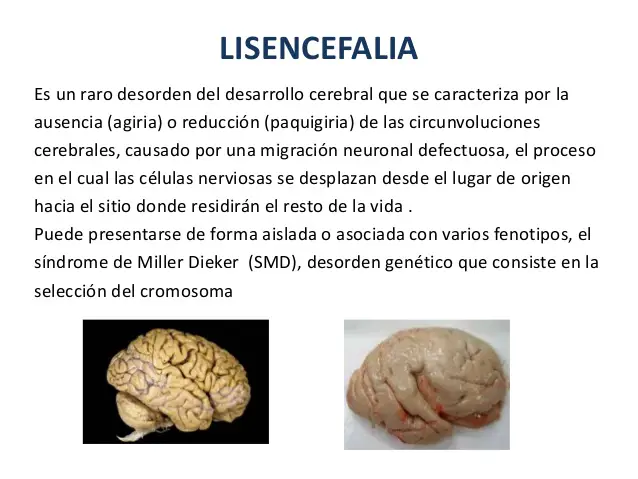 lisenfalia Etiología y clínica del daño cerebral temprano
